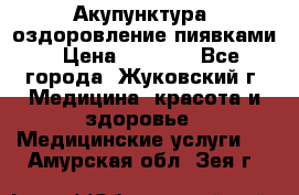 Акупунктура, оздоровление пиявками › Цена ­ 3 000 - Все города, Жуковский г. Медицина, красота и здоровье » Медицинские услуги   . Амурская обл.,Зея г.